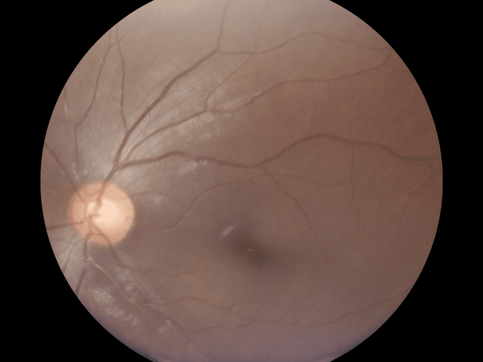 Airdoc AI analysis of a retinal fundus scan